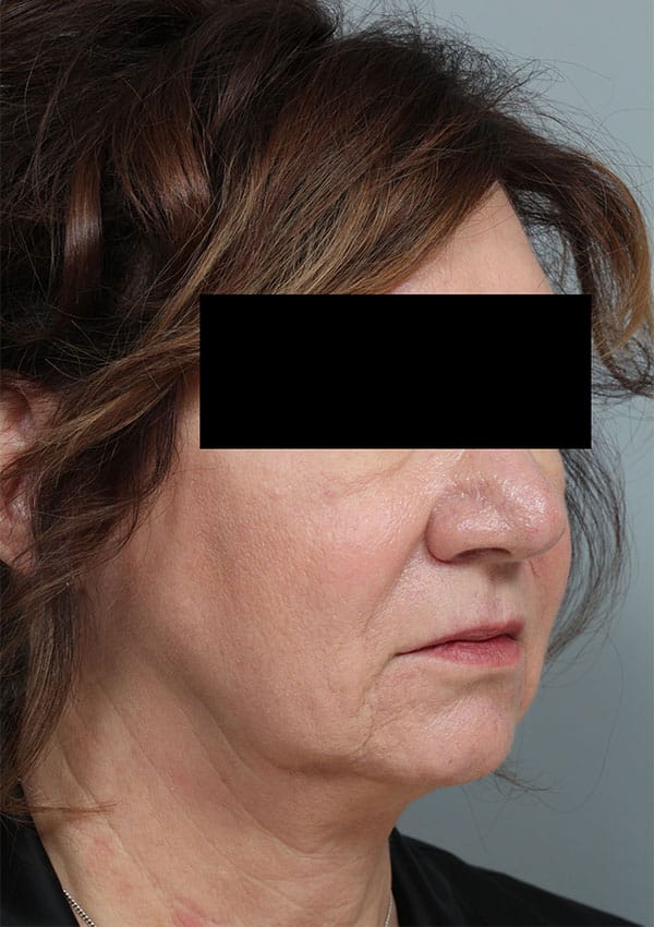 Before Image: Allura Laser Assisted Lipo to Neck - right-front-oblique