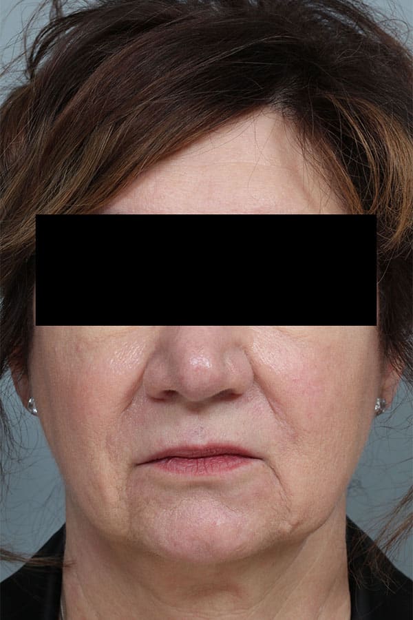 Before Image: Allura Laser Assisted Lipo to Neck - front