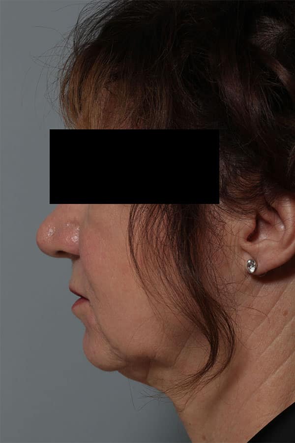 Before Image: Allura Laser Assisted Lipo to Neck - left-side