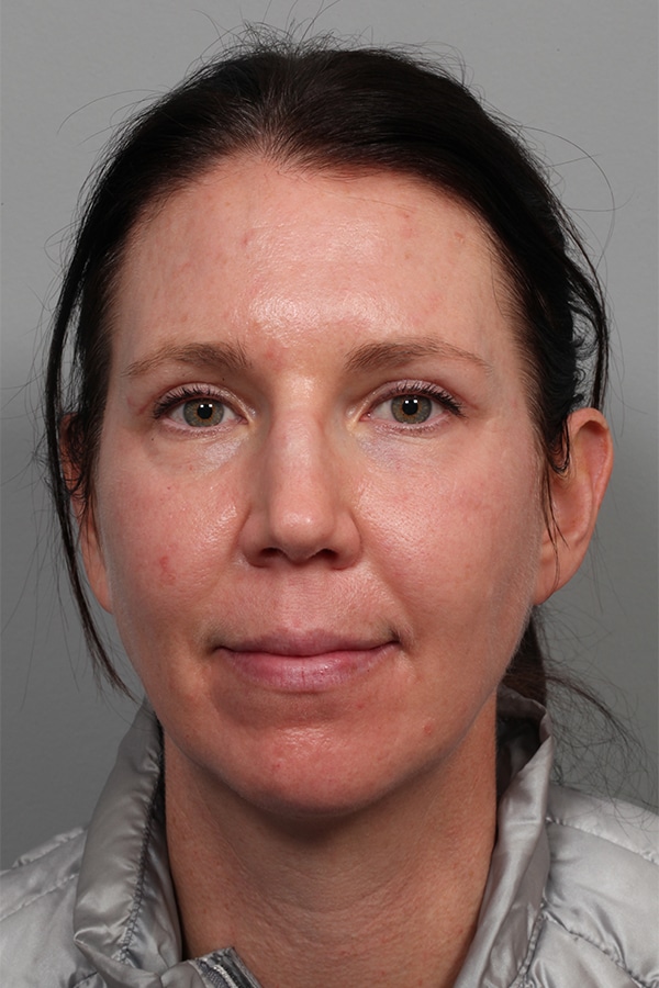 After Image: Upper Blepharoplasty and Laser Resurfacing - front