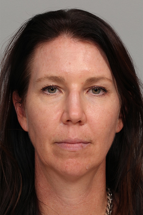 Before Image: Upper Blepharoplasty and Laser Resurfacing - front