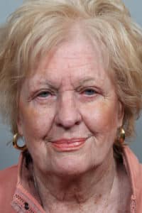 Upper & Lower Blepharoplasty and Ptosis Repair