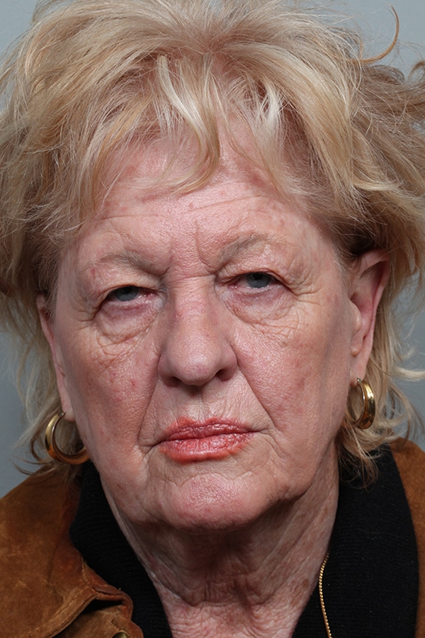 Before Image: Upper & Lower Blepharoplasty and Ptosis Repair - front