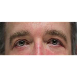 Upper & Lower Blepharoplasty and Laser Resurfacing