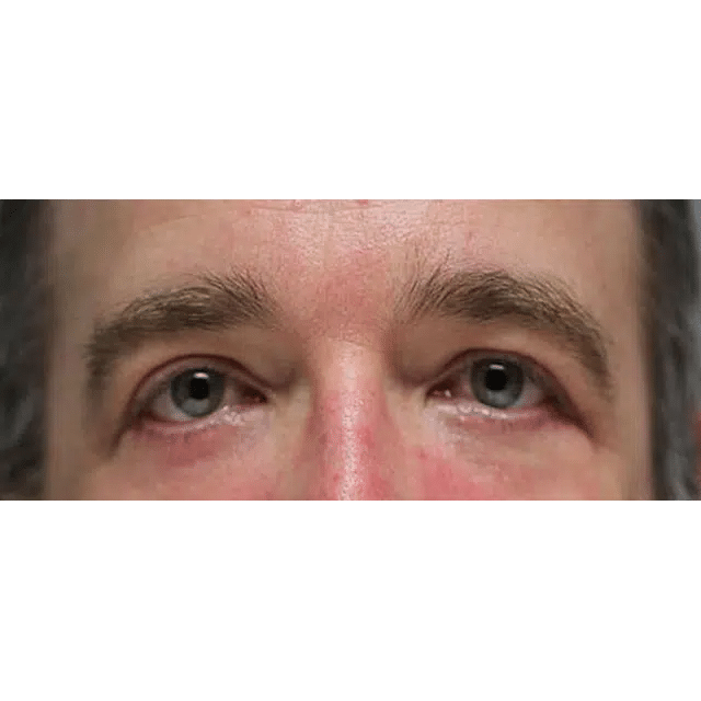 After Image: Upper & Lower Blepharoplasty and Laser Resurfacing - front