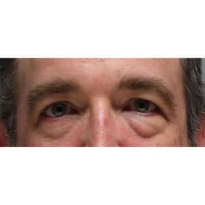 Upper & Lower Blepharoplasty and Laser Resurfacing