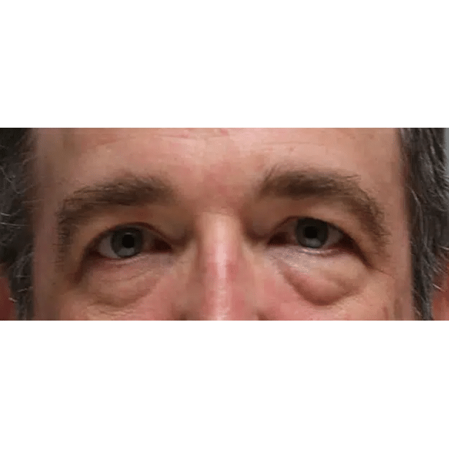 Before Image: Upper & Lower Blepharoplasty and Laser Resurfacing - front