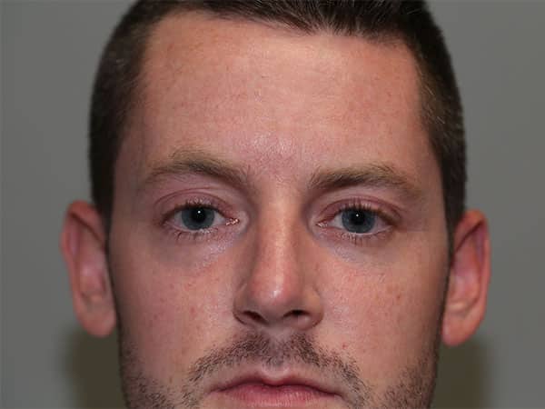 Before Image: Upper Blepharoplasty and Ptosis Repair - front