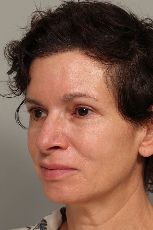 After Image: Upper Blepharoplasty and Left Eyebrow Lift - left-front-oblique