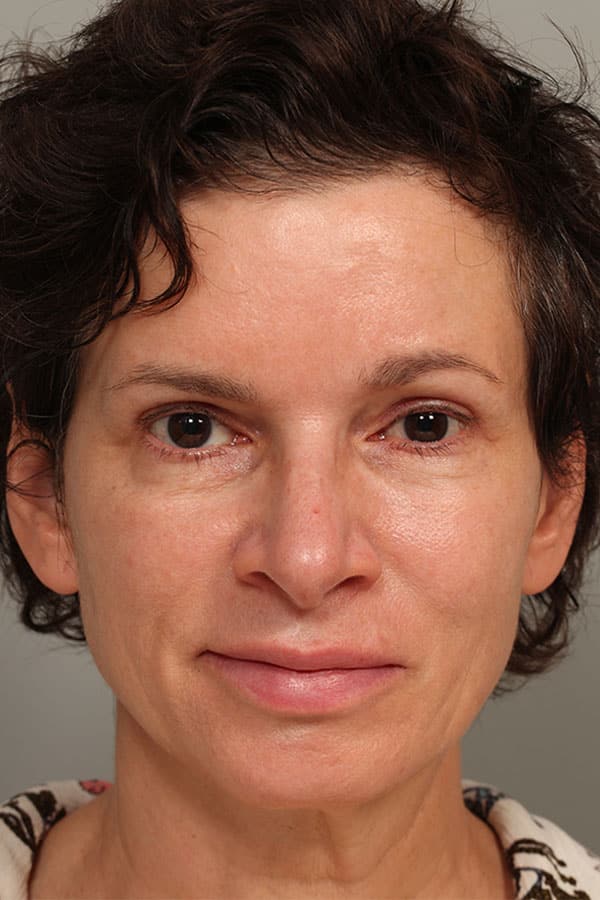 After Image: Upper Blepharoplasty and Left Eyebrow Lift - front