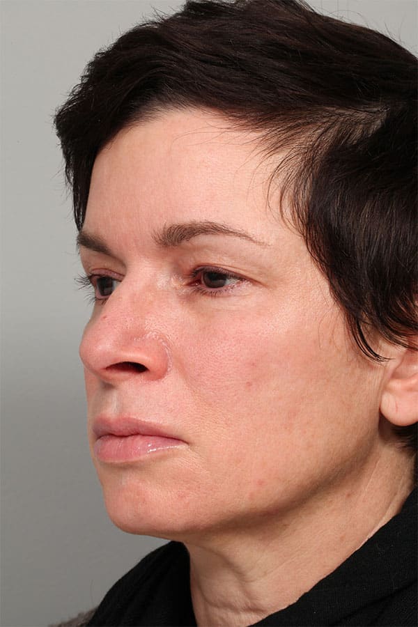 Before Image: Upper Blepharoplasty and Left Eyebrow Lift - left-front-oblique
