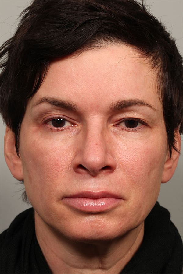 Before Image: Upper Blepharoplasty and Left Eyebrow Lift - front