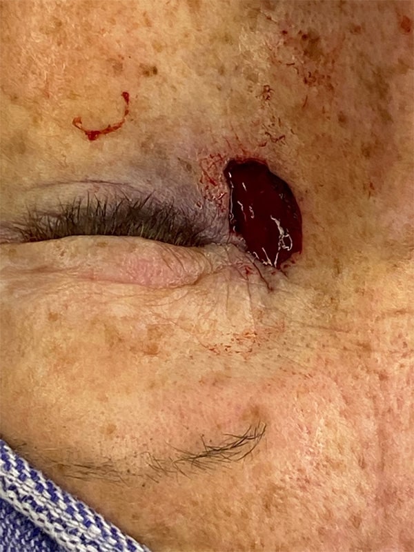 Before Image: Eyelid Reconstruction due to Basal Cell - front