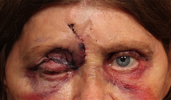 After Image: Orbital Tumor - front