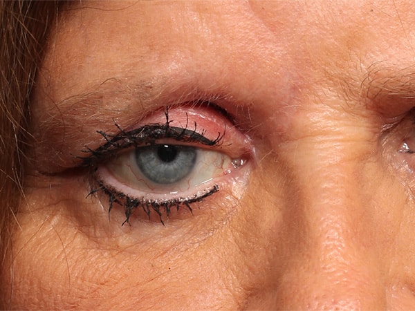After Image: Orbital Tumor - front