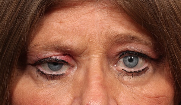 Before Image: Orbital Tumor - front