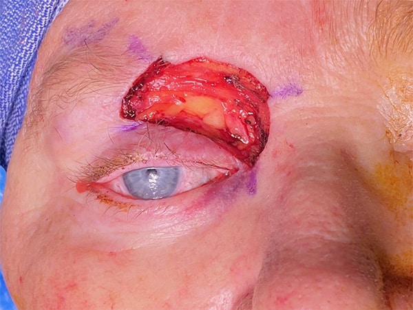 Before Image: Orbital Tumor - front