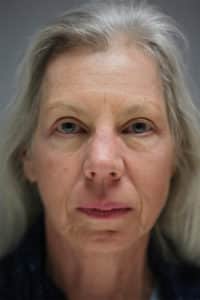 Upper Blepharoplasty