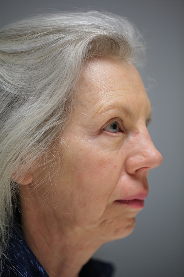 After Image: Upper Blepharoplasty - right-front-oblique