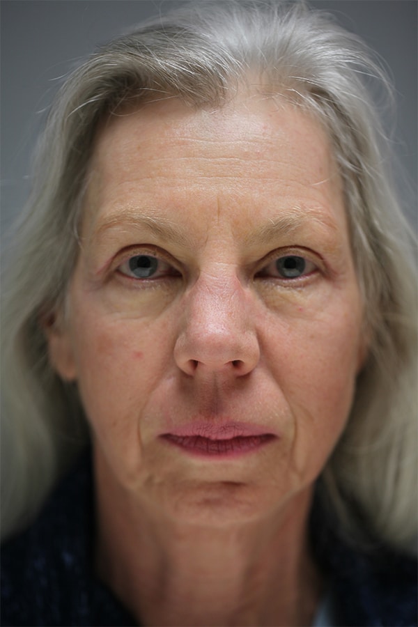After Image: Upper Blepharoplasty - front