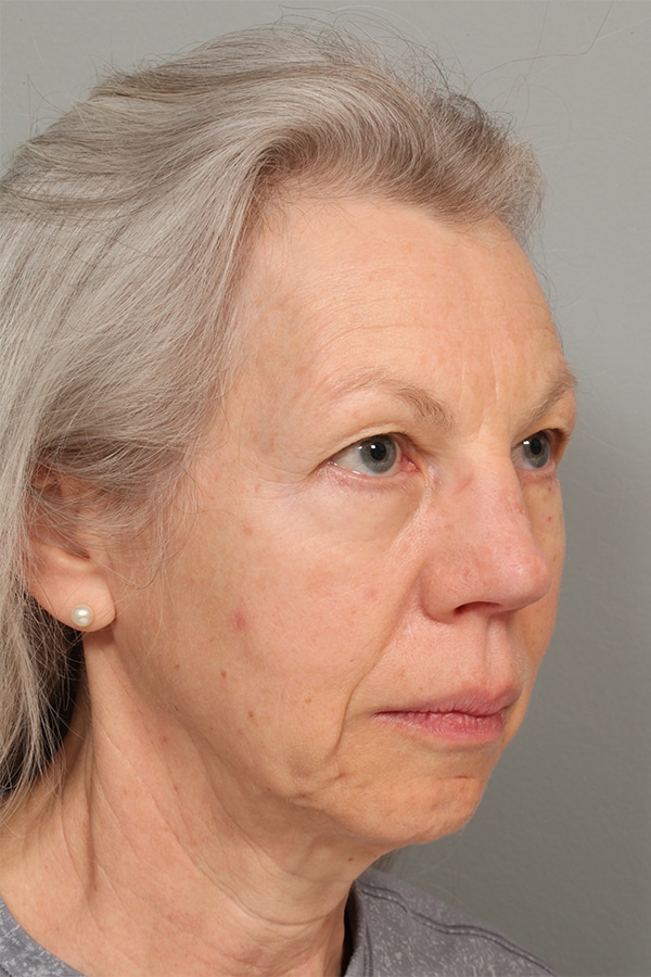 Before Image: Upper Blepharoplasty - right-front-oblique