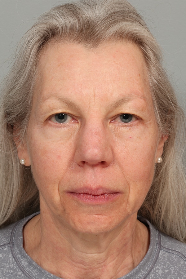 Before Image: Upper Blepharoplasty - front