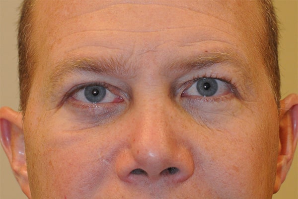 after 3d orbital reconstruction Denver CO