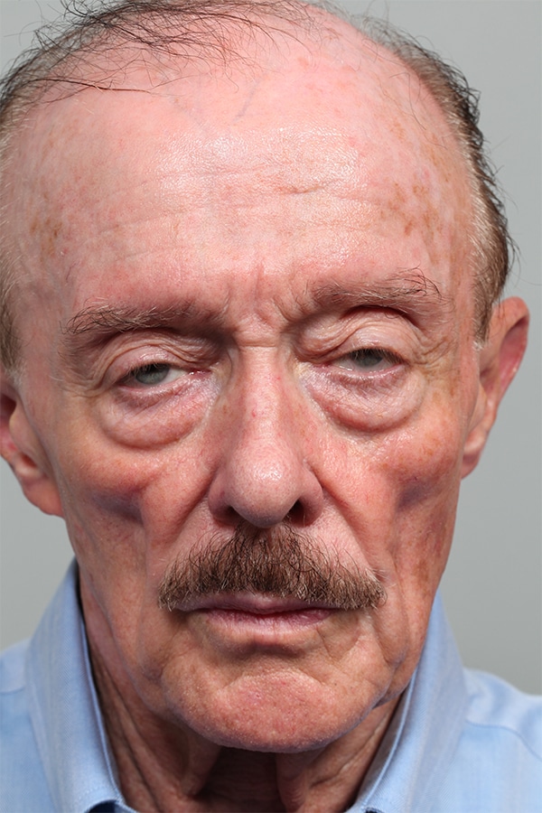Before Image: Eyelid Surgery and Sculptra - front