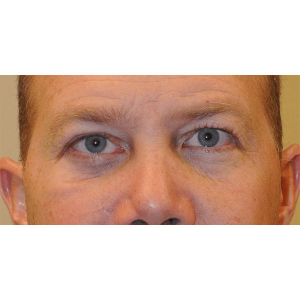 After Image: 3D Orbital Reconstruction - front