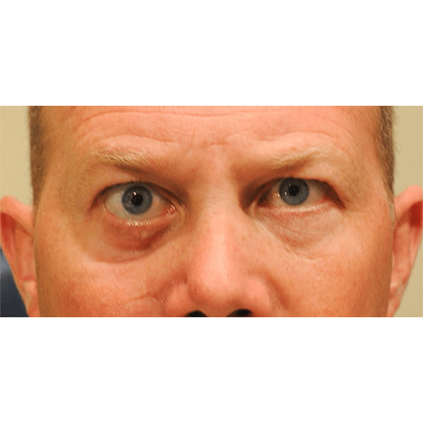 Before Image: 3D Orbital Reconstruction - front