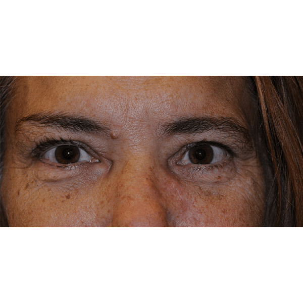 After Image: 3D Orbital Reconstruction - front