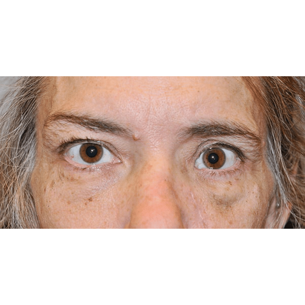 Before Image: 3D Orbital Reconstruction - front