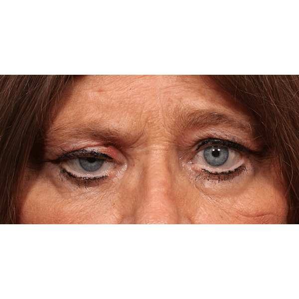Before Image: Orbital Tumor - front