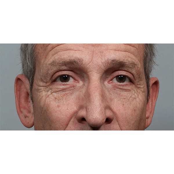 After Image: Upper Blepharoplasty - front