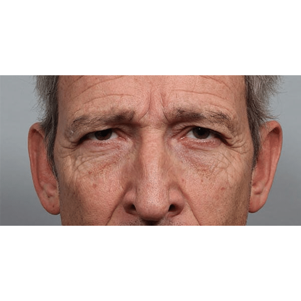 Before Image: Upper Blepharoplasty - front