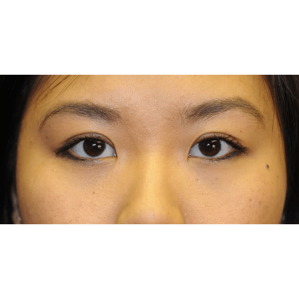 After Image: Asian double eyelid surgery - front