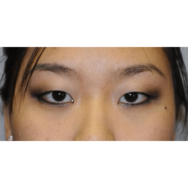 Before Image: Asian double eyelid surgery - front