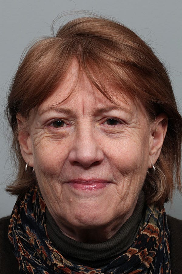 After Image: Upper Blepharoplasty, Lower Blepharoplasty, and Left Browlift - front