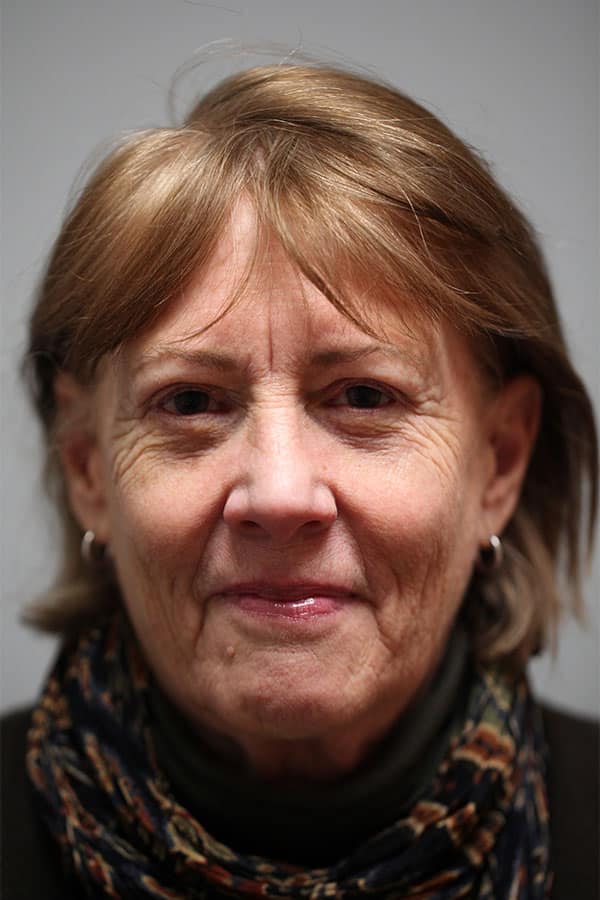 After Image: Upper Blepharoplasty, Lower Blepharoplasty, and Left Browlift - front