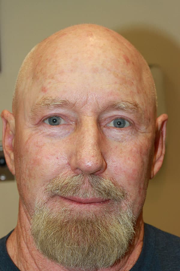 After Image: Upper and Lower Blepharoplasty - front