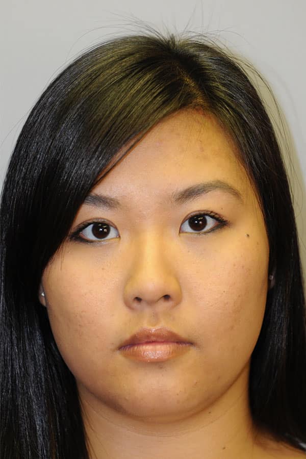 After Image: Asian double eyelid surgery - front