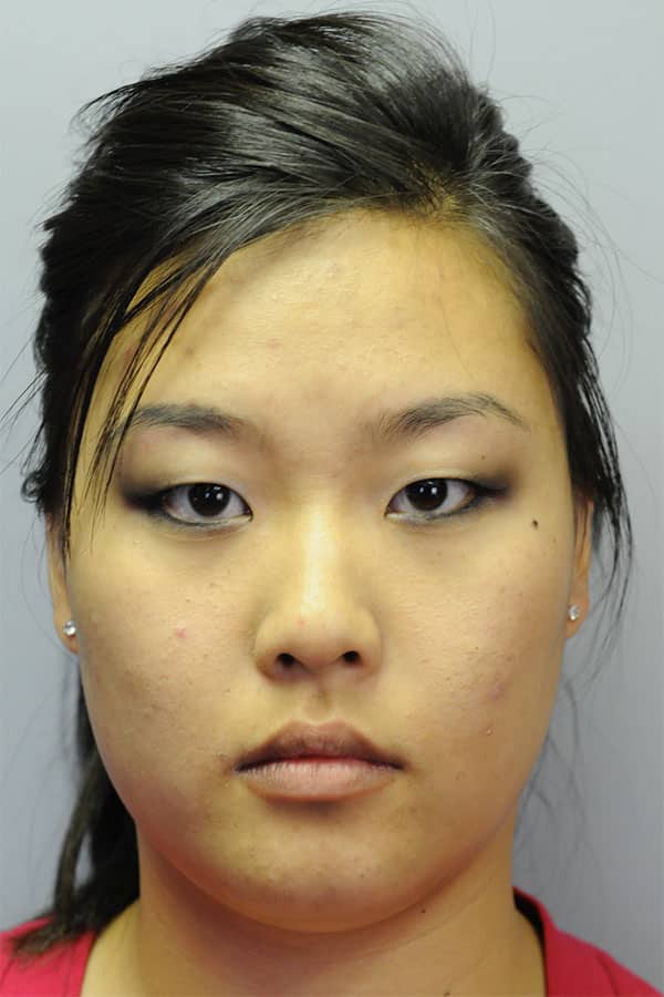 Before Image: Asian double eyelid surgery - front