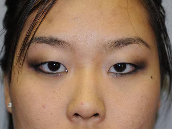 Asian double eyelid surgery
