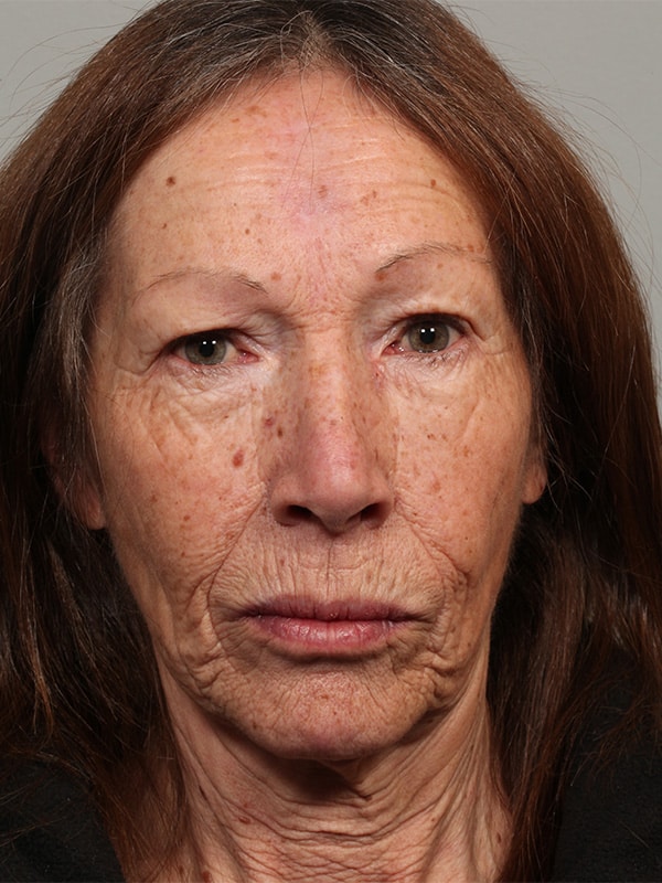 Before Image: Eyelid Reconstruction due to Basal Cell - front