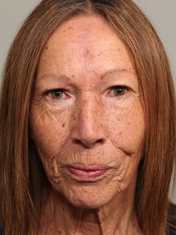 After Image: Eyelid Reconstruction due to Basal Cell - front