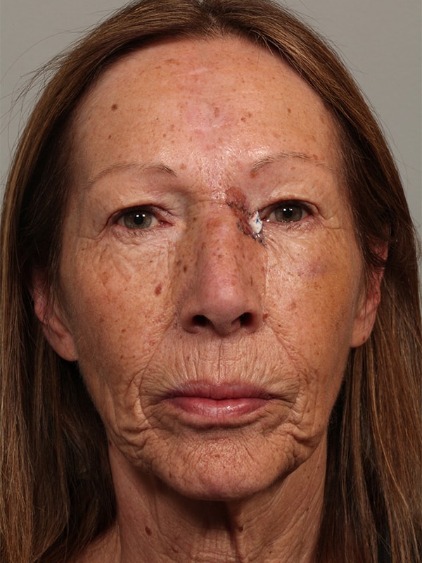 Before Image: Eyelid Reconstruction due to Basal Cell - front