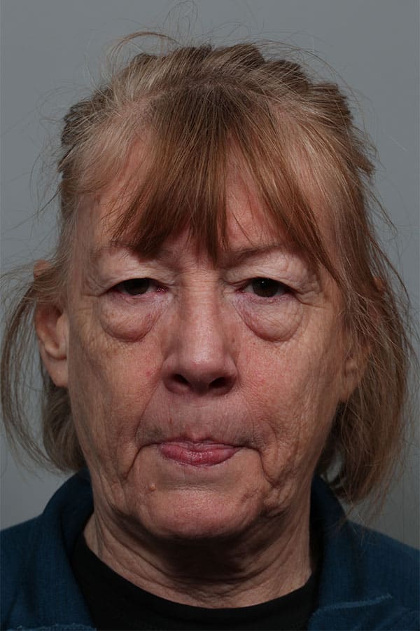 Before Image: Upper Blepharoplasty, Lower Blepharoplasty, and Left Browlift - front