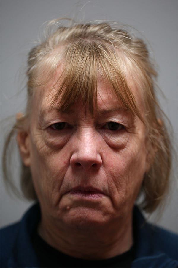 Before Image: Upper Blepharoplasty, Lower Blepharoplasty, and Left Browlift - front
