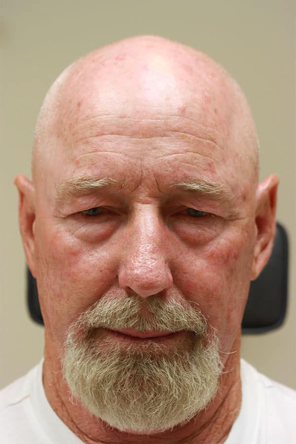 Before Image: Upper and Lower Blepharoplasty - front
