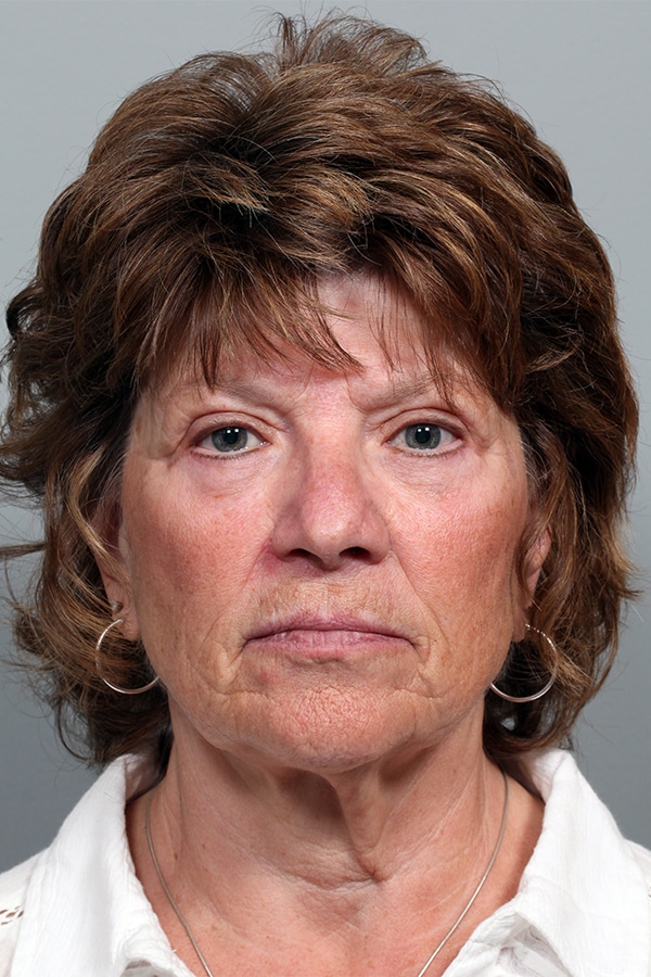 After Image: Upper and Lower Blepharoplasty - front